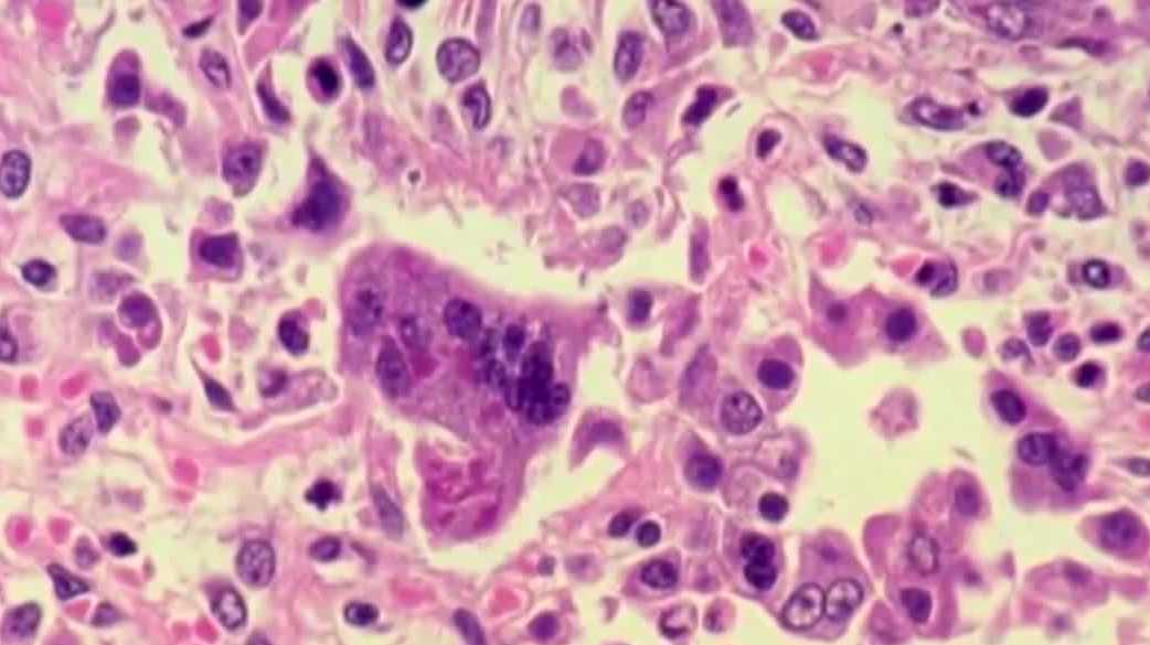 Polk County testing dozens for measles after a vaccinated resident is infected