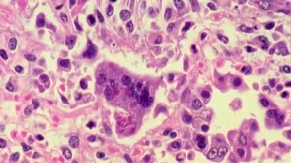 polk county testing dozens for measles after a vaccinated resident is infected