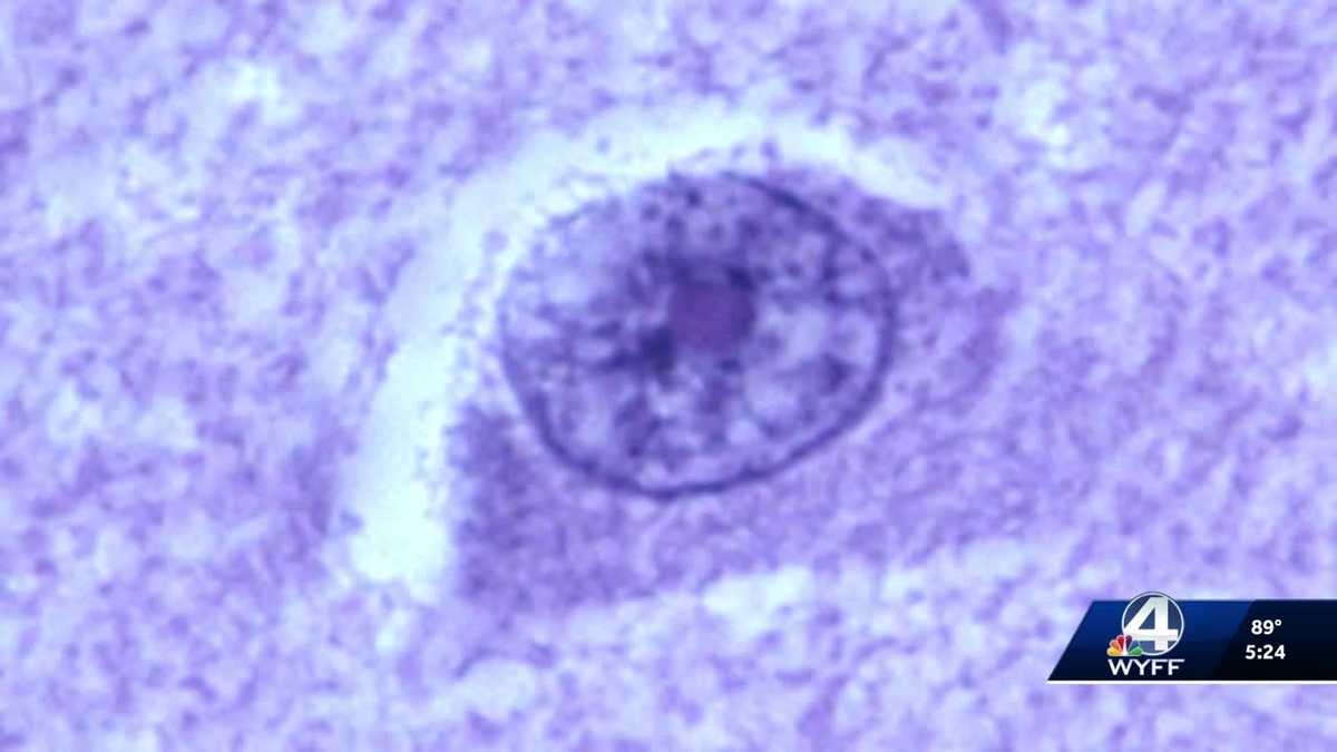 Brain-eating amoeba infection leaves teen in NC in critical condition, health officials report