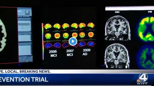 Preventing Alzheimer's disease is goal of breakthrough therapy - Vimarsana News