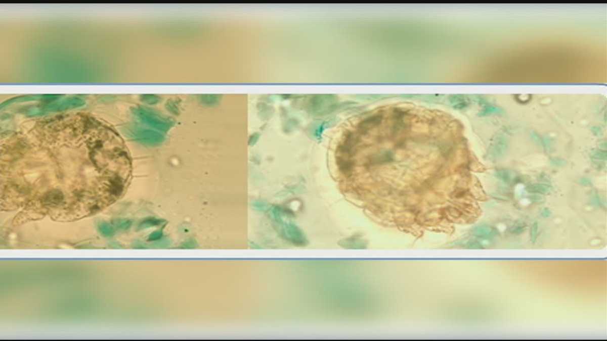 Scabies Outbreak Grows Scabies Outbreak Grows