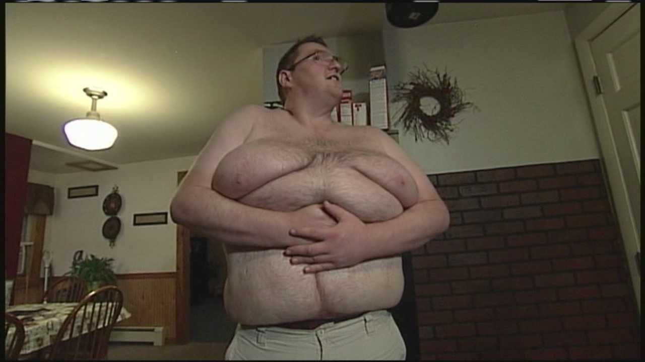 Once 800 pound man left with pounds of skin