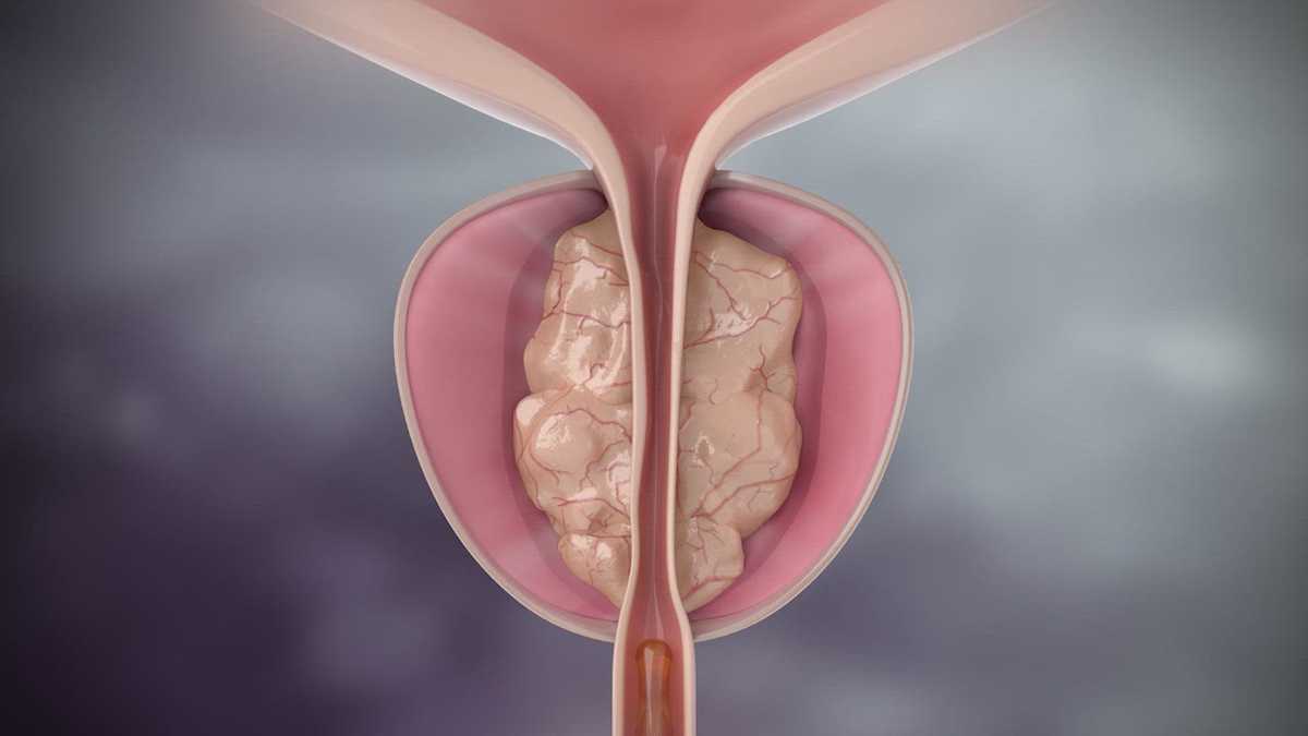 Rezūm: a minimally invasive option for BPH at Beaufort - WJCL