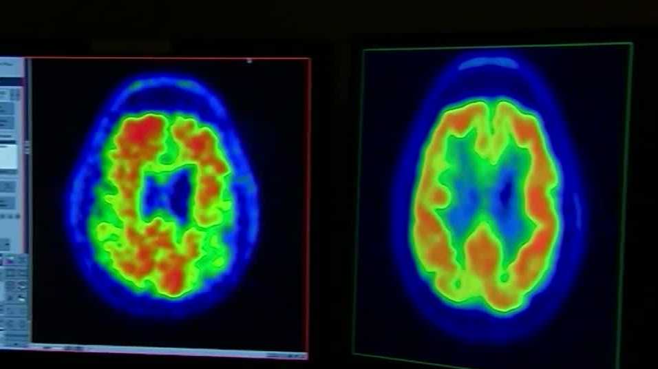 Louisville doctor believes new Alzheimer drug will be approved by FDA - Vimarsana News