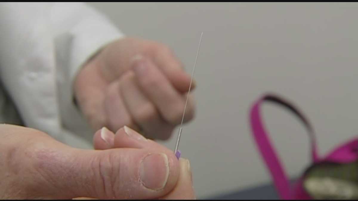 Acupuncture to help with pregnancy