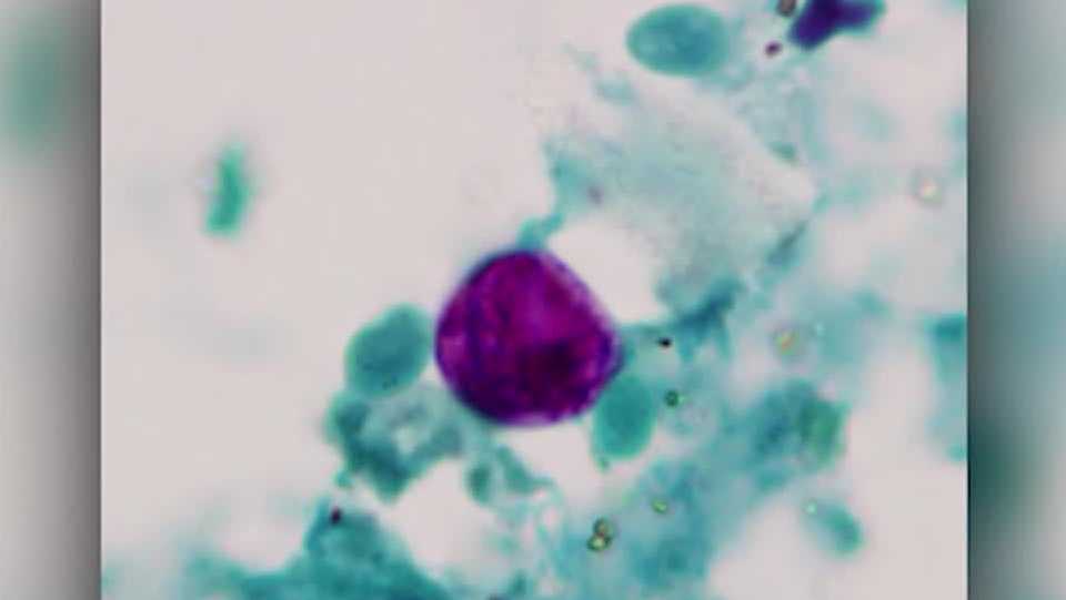 Kentucky, Indiana health departments reporting higher numbers of cyclosporiasis cases