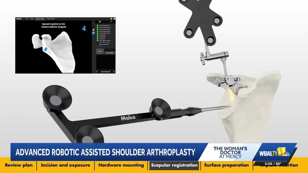 Woman's Doctor: New shoulder replacement robot helps personalize treatment