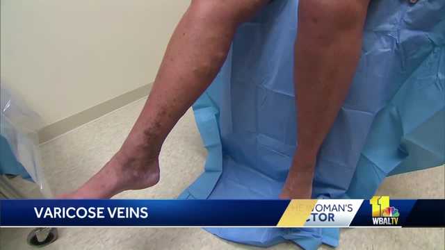 The Woman's Doctor: Risk factors of varicose veins for women