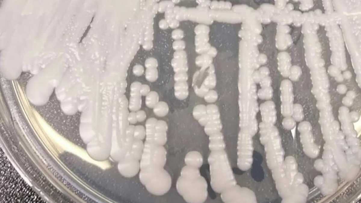 CDC Superbug Fungus Emerges in U.S.