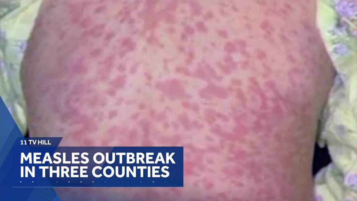 11 TV Hill: Measles tips shared for families as school starts