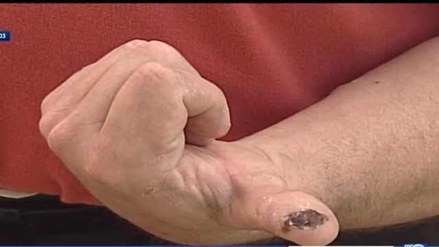 Man who survived 2003 monkeypox outbreak describes what it was like - Vimarsana News