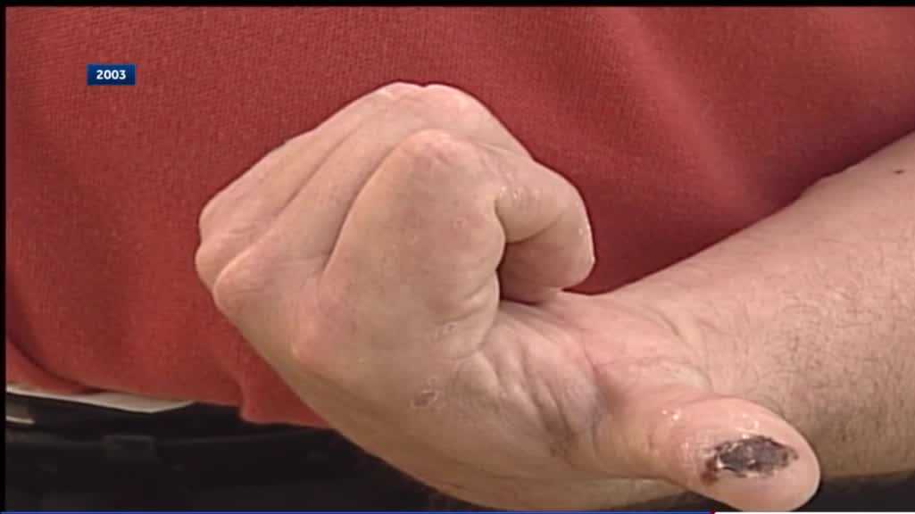 2003 Wisconsin monkeypox survivor reflects on outbreak