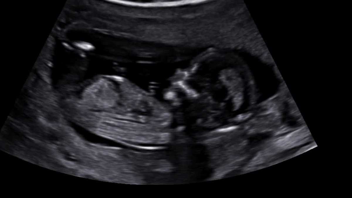 GMA 'Miracle' baby born to Kearney mom who had fallopian tubes removed