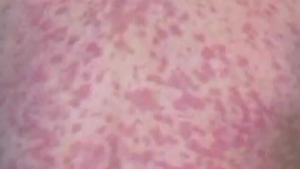 Collier County confirms 2 more measles cases, total nears 110 in Southwest Florida