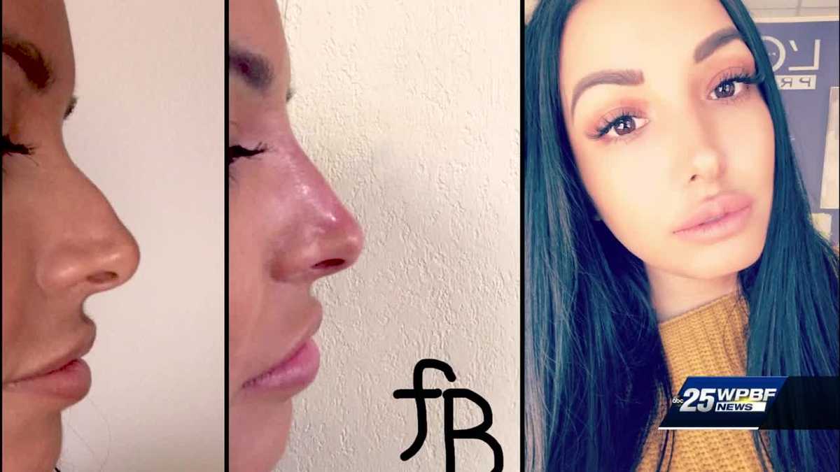 Snapchat dysmorphia causing people to go under the knife