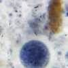 Cyclosporiasis cases rise in Florida as testing remains costly and limited