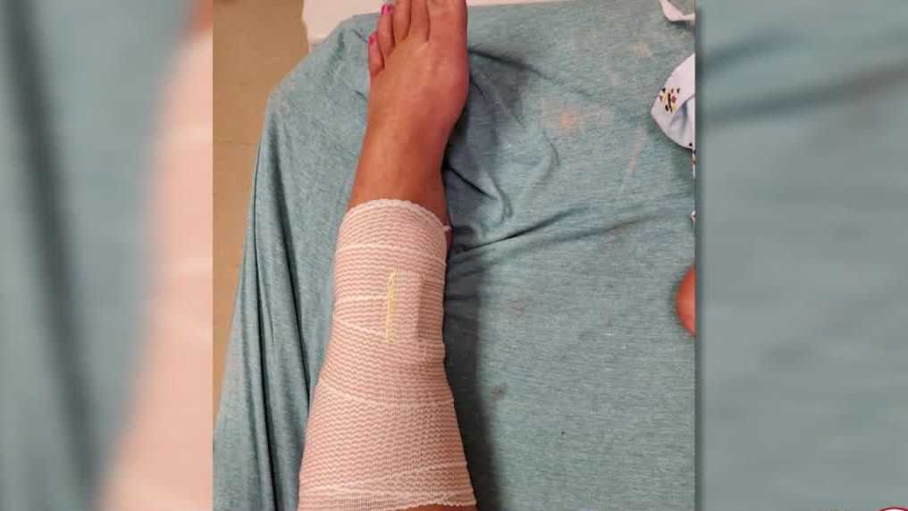 Woman attacked by shark in Volusia County recounts attack - Vimarsana News
