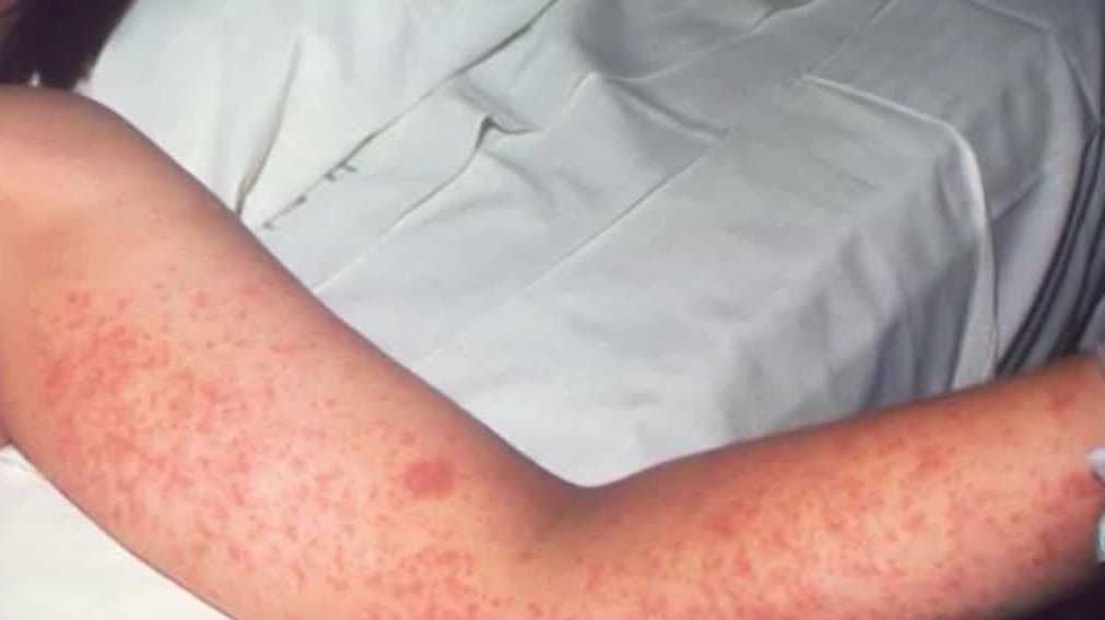 3 new measles cases reported in eastern Iowa