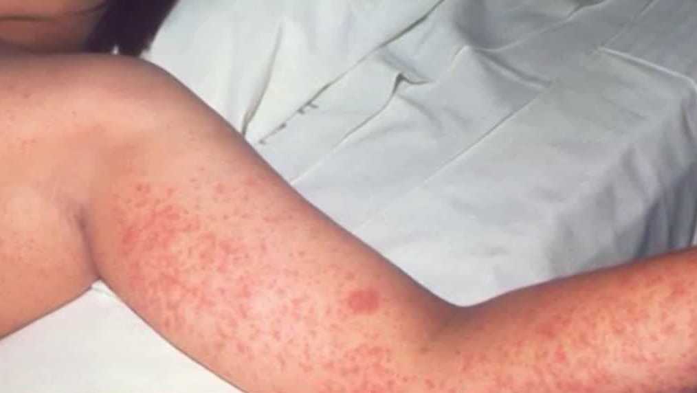 Health officials confirm case of measles in Polk County