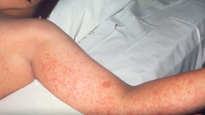 Dermatologist explains when you should begin to worry about a rash