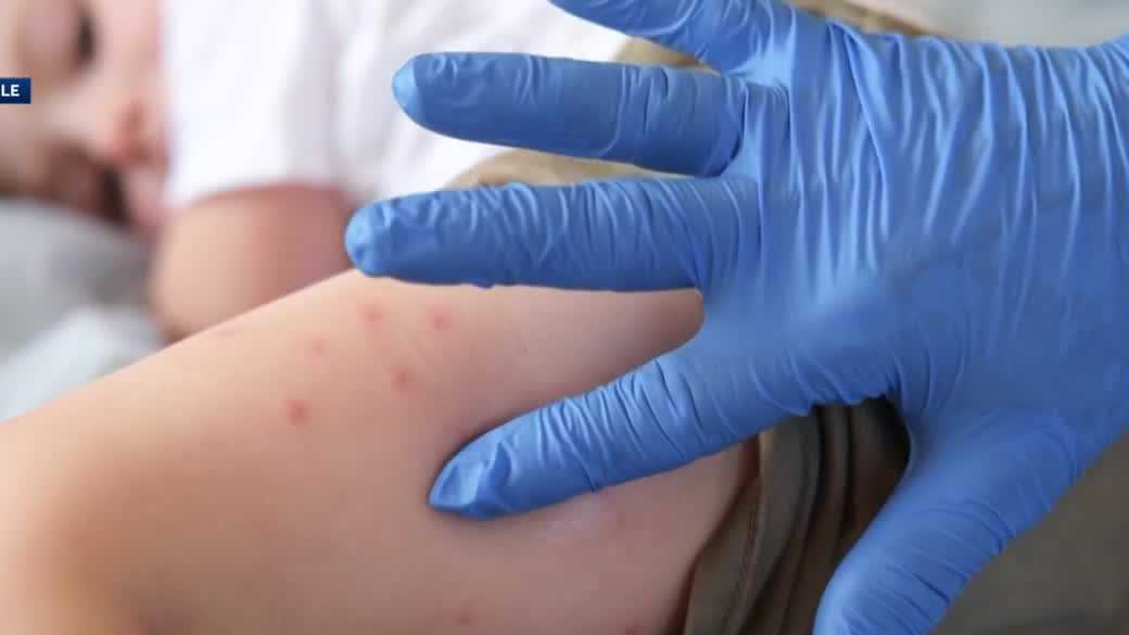 Health officials issue urgent advisory due to 'rampant spread' of measles
