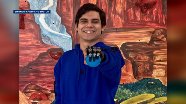 20-year-old graduates from Boston hospital with new prosthetic hand