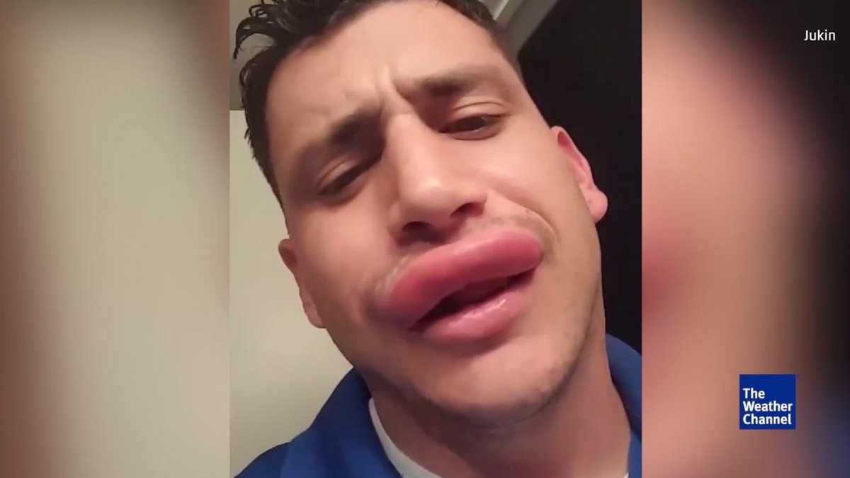 Man Shows Off Luscious Lips From Wasp Stings