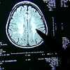 At least 1 in 4 NFL players had brain disease CTE, Mass General Brigham study finds