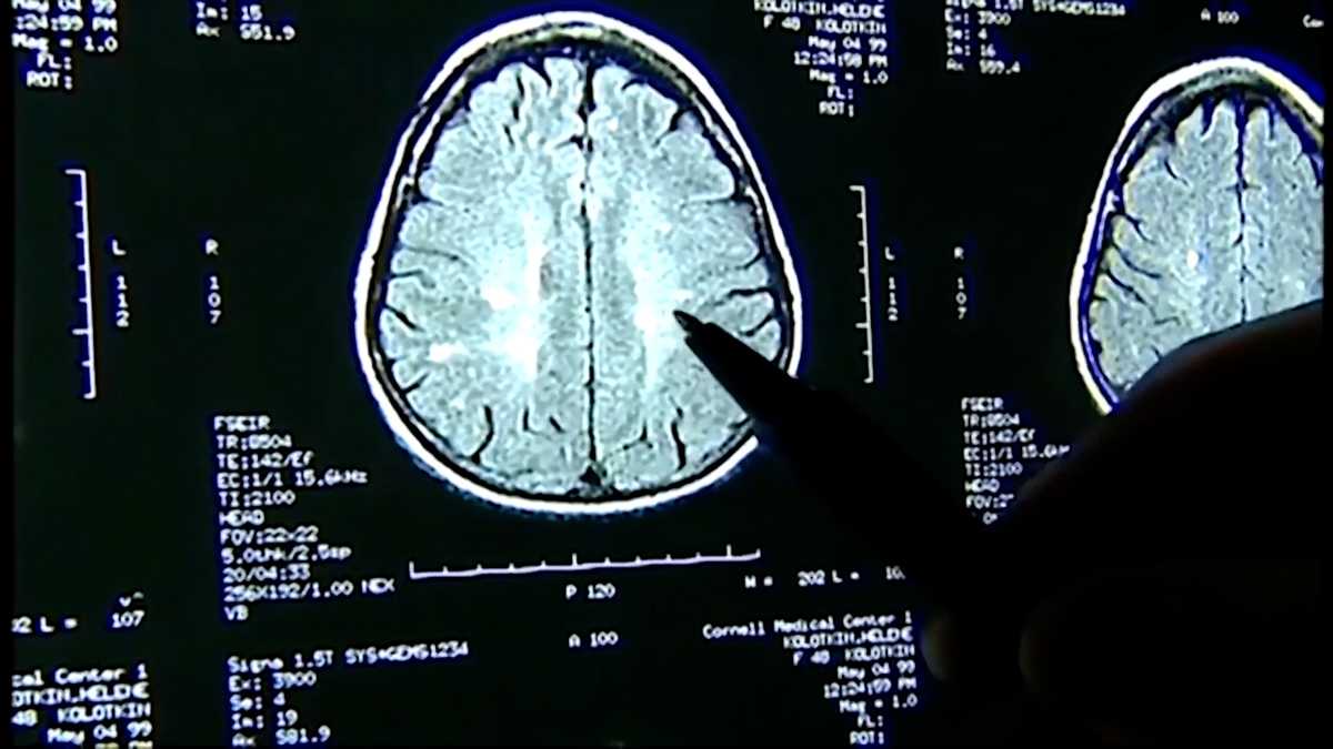 波士顿大学研究人员发现年轻运动员的脑中存在慢性脑损伤，提出预防是可能的