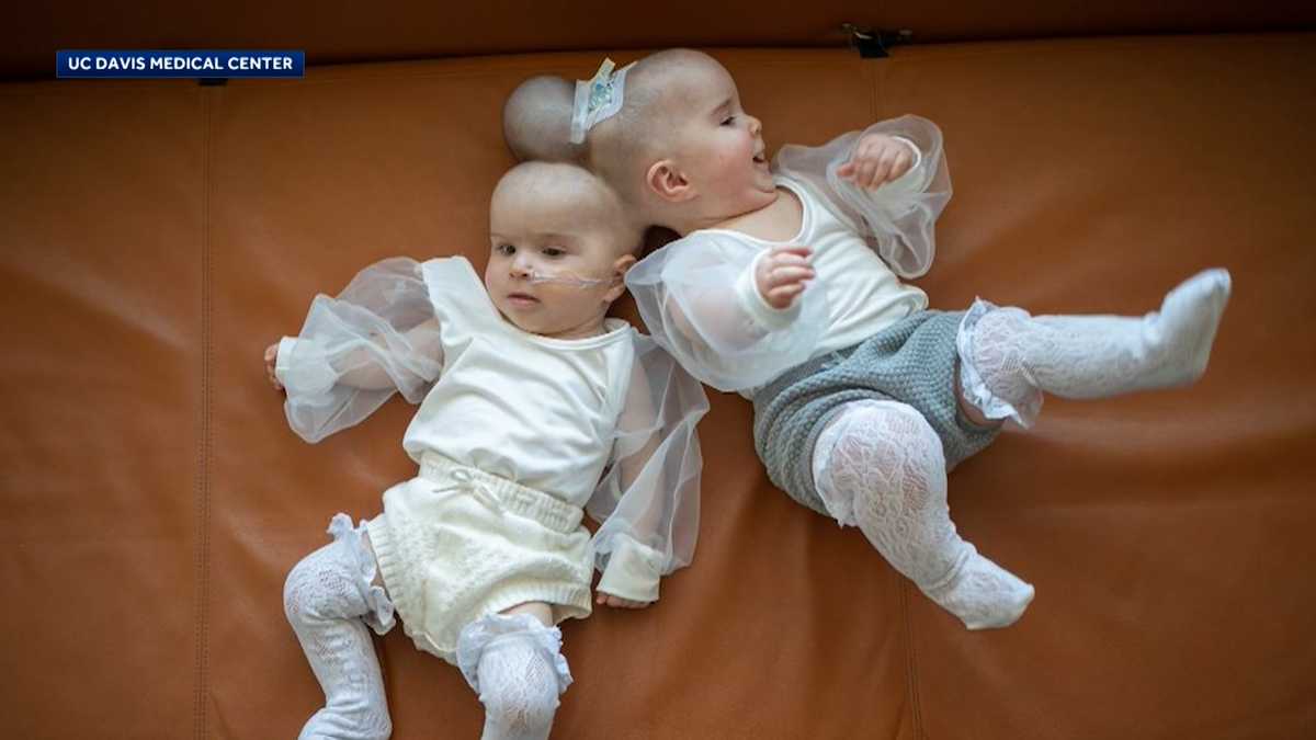Conjoined twins opened up on what their life was like after becoming  teachers