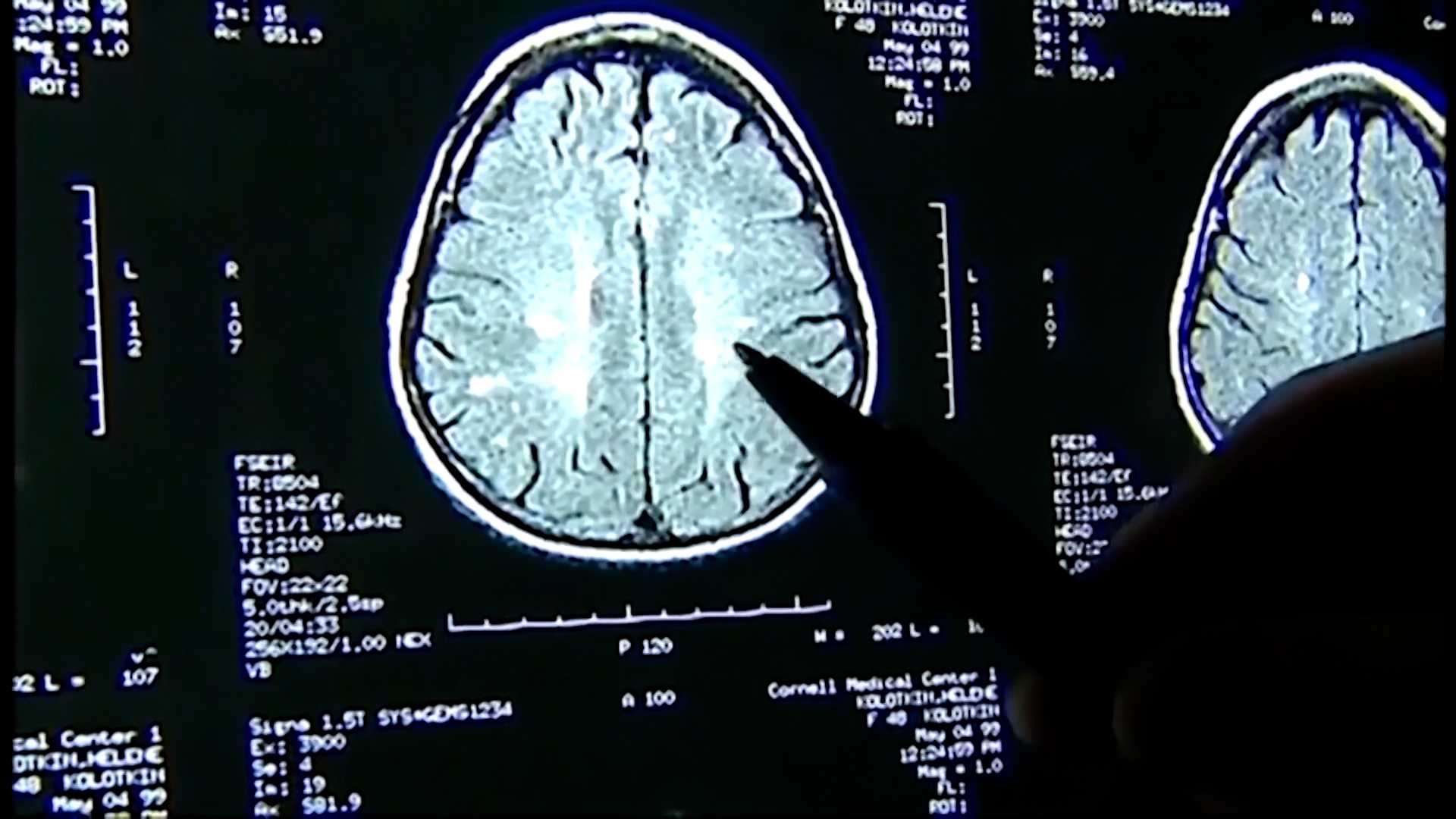 Boston study: Concussions not biggest factor in CTE development - Vimarsana News