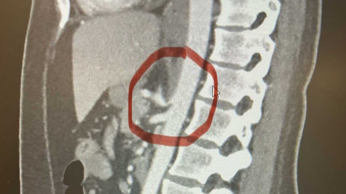 Median Arcuate Ligament Syndrome | Orlando surgeon explains signs, symptoms and treatment