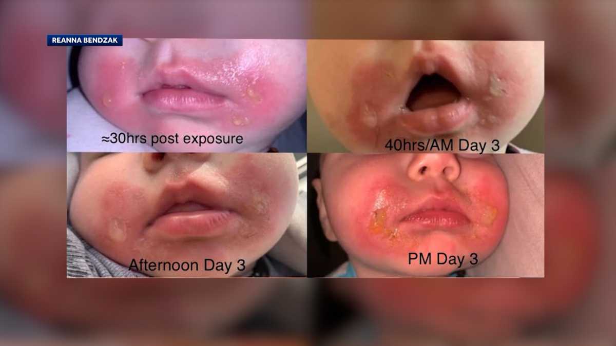 Boston doctor explains how to treat, prevent 'margarita burn'