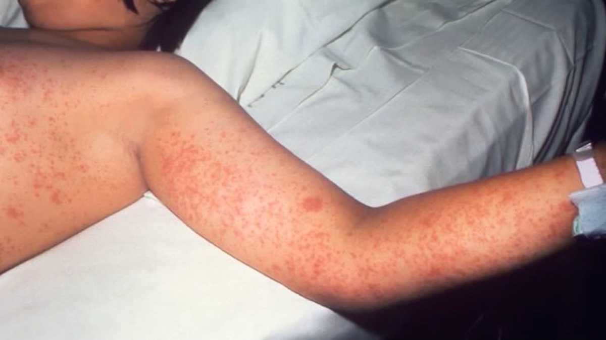 What to know as measles cases hit new record in U.S.