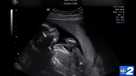 Florida Abortion Law goes in effect