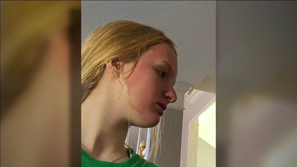Teen says face mask burned her skin like fire as company investigates