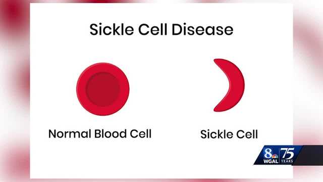 What is sickle cell disease? - Vimarsana News