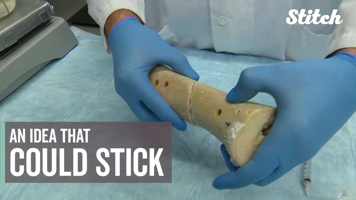 Startup hopes 'bone glue' is an idea that can stick