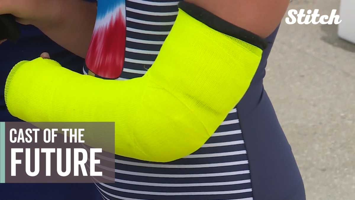 Waterproof cast helping kids get back in the water this summer