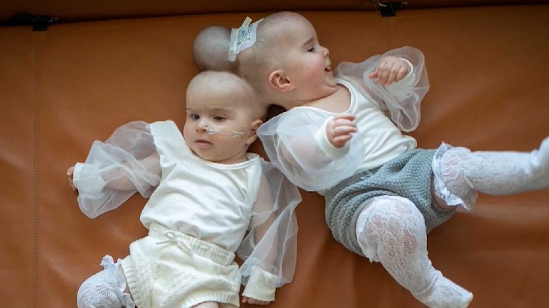 'They Both Are Really Happy Babies:' Rare Conjoined Twins Successfully ...