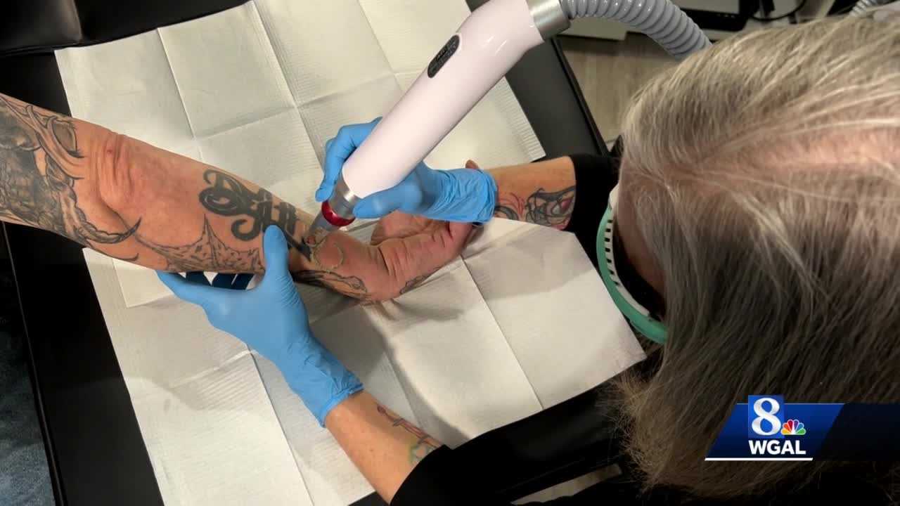 Laser technology makes tattoo removal easier faster