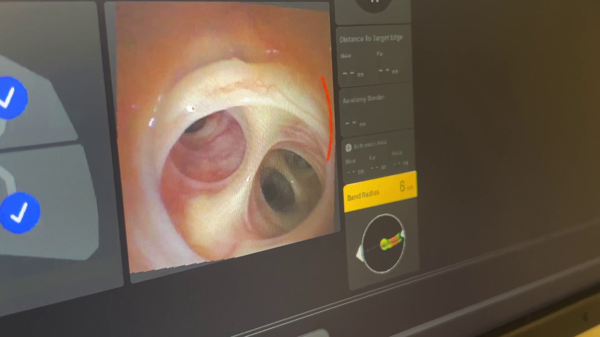 New robotic device aids early lung cancer detection at NCH