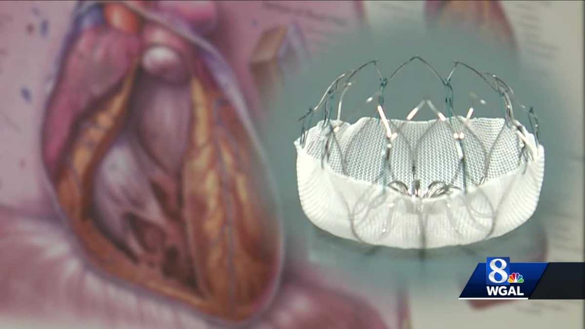 Watchman device helps patients with AFib
